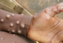 Sedes de Chuquisaca emite alerta epidemiológica por caso de viruela del mono