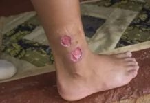 Confirman caso de leishmaniasis visceral en Villa Montes