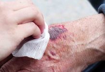 Bolivia registra 482 casos de lepra en 10 años, el diagnóstico y tratamiento es gratuito en el SUS